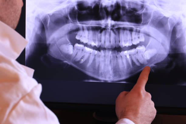 Best Emergency Wisdom Teeth Removal in Algonquin, IL