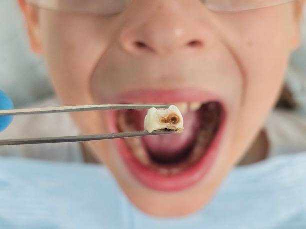 Best Pediatric Emergency Dentist in Algonquin, IL